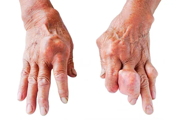 Ουρική Αρθρίτιδα: Αίτια και Αντιμετώπιση