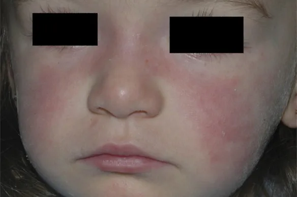 Ερυθηματώδης Λύκος