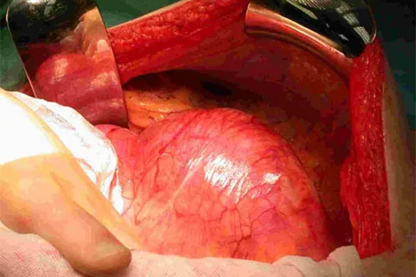 Ανεύρισμα Κοιλιακής Αορτής