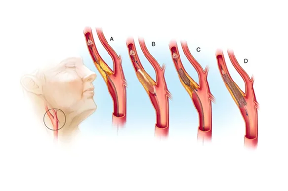 Στένωση Καρωτίδων