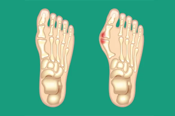 Βλαισος μεγας δακτυλος – «κοτσι» - hallux valgus