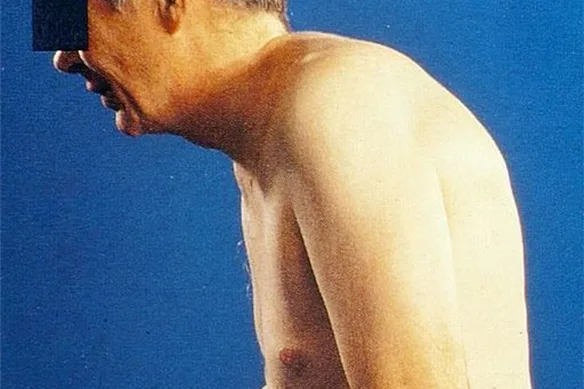 Αγκυλοποιητική Σπονδυλαρθρίτιδα και Αντιφλεγμονώδη Φάρμακα