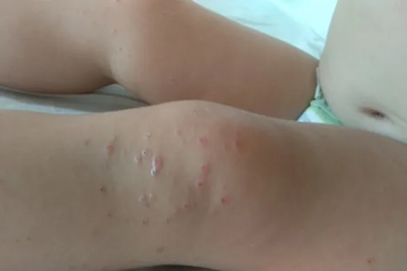 Νόσος  χεριών - ποδιών - στόματος