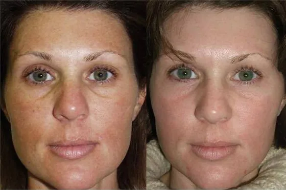 Fractional laser – Η αποτελεσματικότερη θεραπεία ανανέωσης!