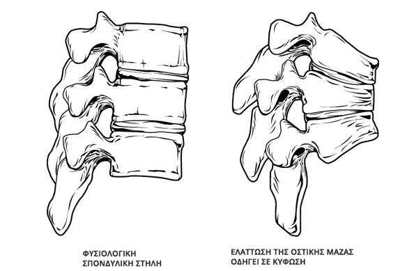 Οστεοπόρωση: Συμπτώματα και Αντιμετώπιση