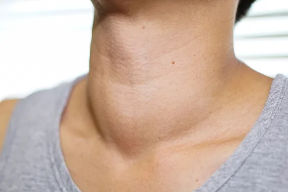 Τί είναι ο υπερθυρεοειδισμός με λίγες λέξεις