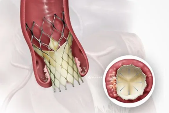 Βαλβίδα στη βαλβίδα: ασφαλές;