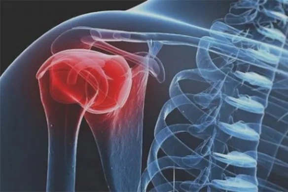 Σχετικά με την ρήξη του στροφικού πετάλου