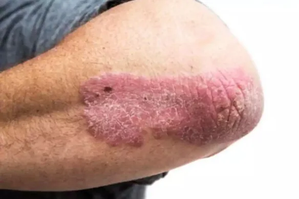 Θεραπεία της ψώρας