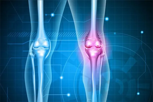 Οστεοαρθρίτιδα ισχίου και γόνατος