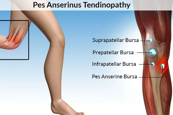 Τενοντίτιδα χήνειου πόδα-πόνος κάτω του γόνατος