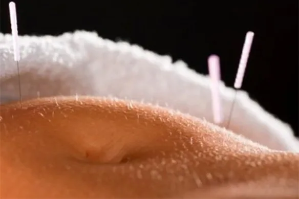 Ο Βελονισμός κατά της Παχυσαρκίας