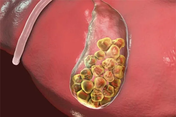 Κολικός Χοληφόρων - Χολολιθίαση