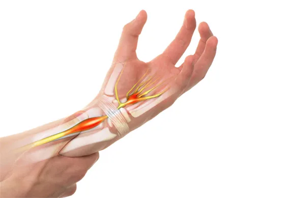 Σύνδρομο καρπιαίου σωλήνα