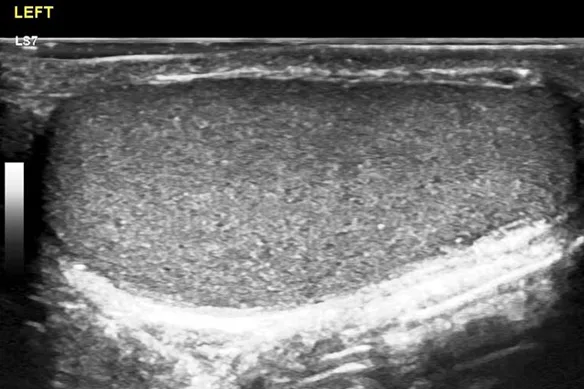 Υπερηχογράφημα Αμυγδαλών