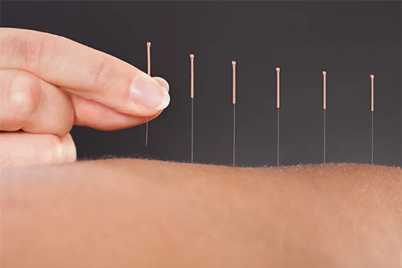 Βελονισµός, µία εντελώς ανώδυνη διαδικασία