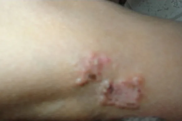 Σταφυλοκοκκική λοίμωξη δέρματος