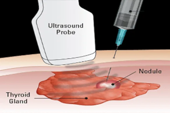 FNA Συχνές Ερωτήσεις