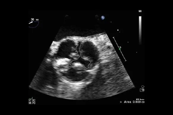 Στένωση της αορτικής βαλβίδας