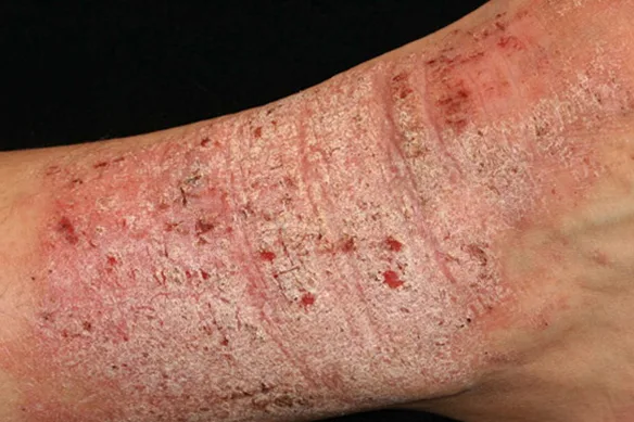 Ο ήλιος καταπραΰνει το έκζεμα