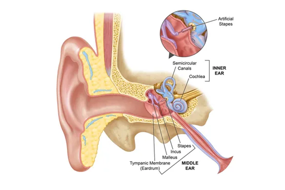 Ωτοσκλήρυνση