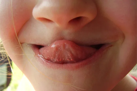 Κοντός χαλινός της γλώσσας