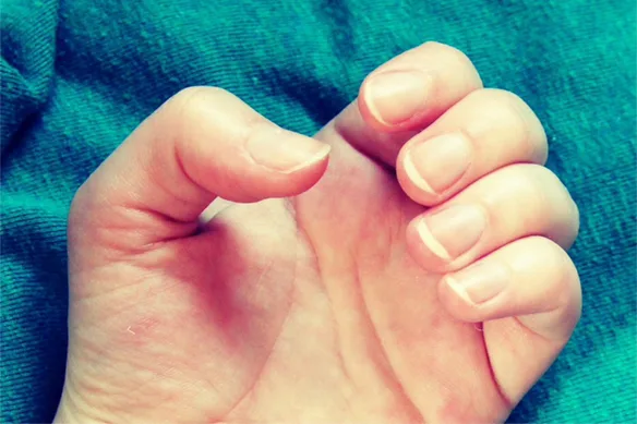 Ρήξεις καμπτήρων τενόντων